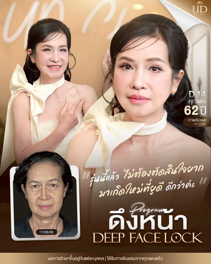 LINE_ALBUM_UD-ศัลยกรรมดึงหน้า 2_260908_1