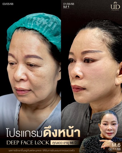 LINE_ALBUM_UD-ศัลยกรรมดึงหน้า 2_260908_2