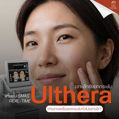 14.1 UD _ เจาะลึก Ulthera ยิงยกกระชับ แบบเห็นชั้น SMAS Real-time ต่างจากเครื่องยกกระชับทั่วไปอย่างไร_
