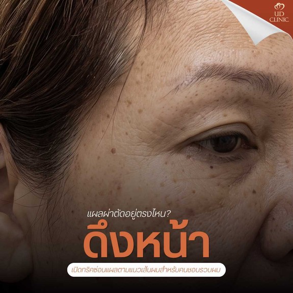 39.1 UD _ ดึงหน้า Deep Face Lock แผลผ่าตัดอยู่ตรงไหน_ เปิดทริคซ่อนแผลตามแนวเส้นผมสำหรับคนชอบรวบผม