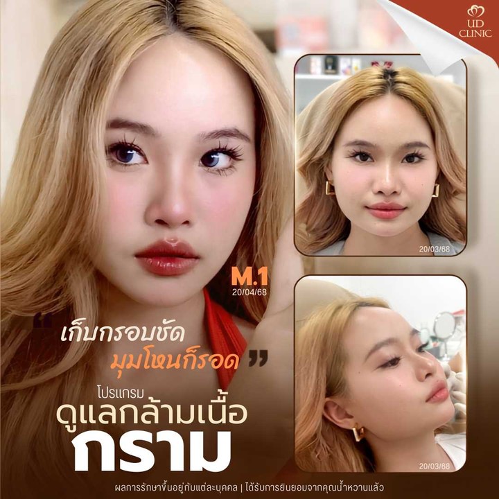 26.4 UD _ สายหมูกระทะฟังทางนี้ กรามใหญ่จากพฤติกรรม ฉีดโบกรามกี่ยูนิตถึงจะเอาอยู่_