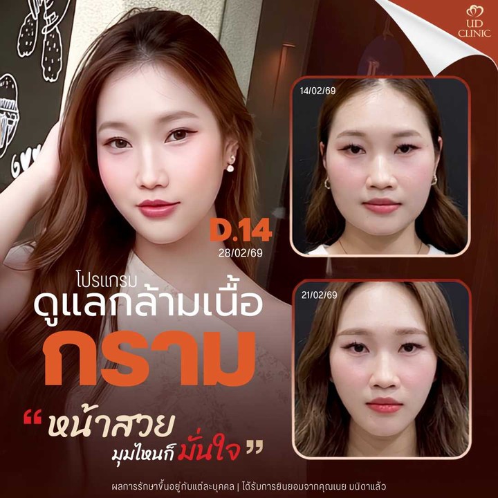 26.5 UD _ สายหมูกระทะฟังทางนี้ กรามใหญ่จากพฤติกรรม ฉีดโบกรามกี่ยูนิตถึงจะเอาอยู่_