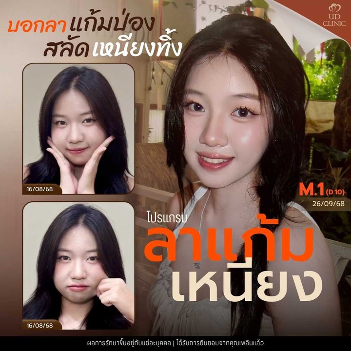 39.5 UD _ เหนียงยุบแต่ผิวย้วย_ ฉีดแฟตสลายไขมันแก้ม-เหนียงอย่างไรไม่ให้ผิวเสียความยืดหยุ่น