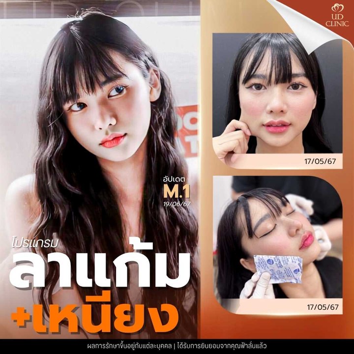 39.3 UD _ เหนียงยุบแต่ผิวย้วย_ ฉีดแฟตสลายไขมันแก้ม-เหนียงอย่างไรไม่ให้ผิวเสียความยืดหยุ่น