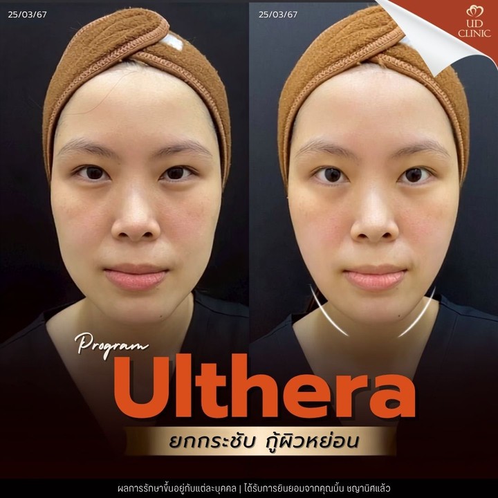 55.4 UD _ Ulthera เหมาะกับคนอายุเท่าไหร่_ ทำไมวัย 30+ ถึงควรเริ่มทำ Ulthera กระตุ้นคอลลาเจนก่อนผิวทรุด