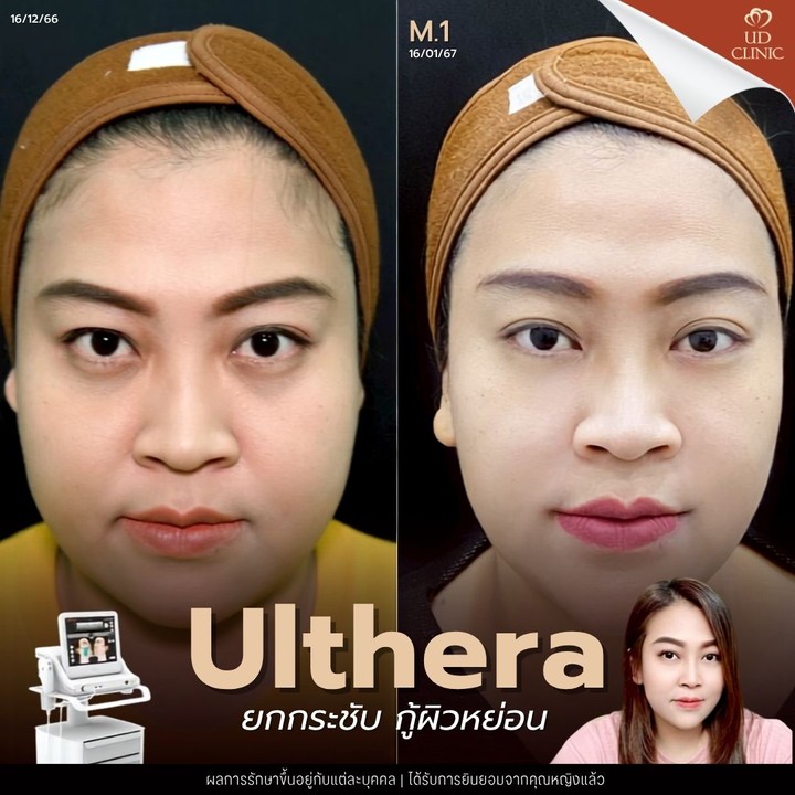 55.3 UD _ Ulthera เหมาะกับคนอายุเท่าไหร่_ ทำไมวัย 30+ ถึงควรเริ่มทำ Ulthera กระตุ้นคอลลาเจนก่อนผิวทรุด