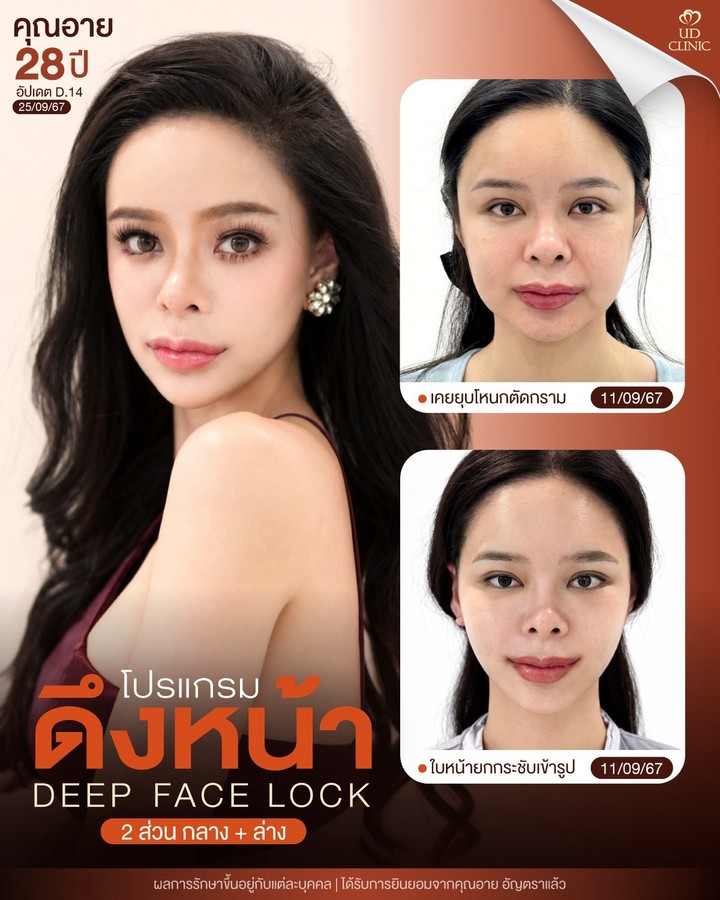 LINE_ALBUM_UD-ศัลยกรรมดึงหน้า 2_261012_1