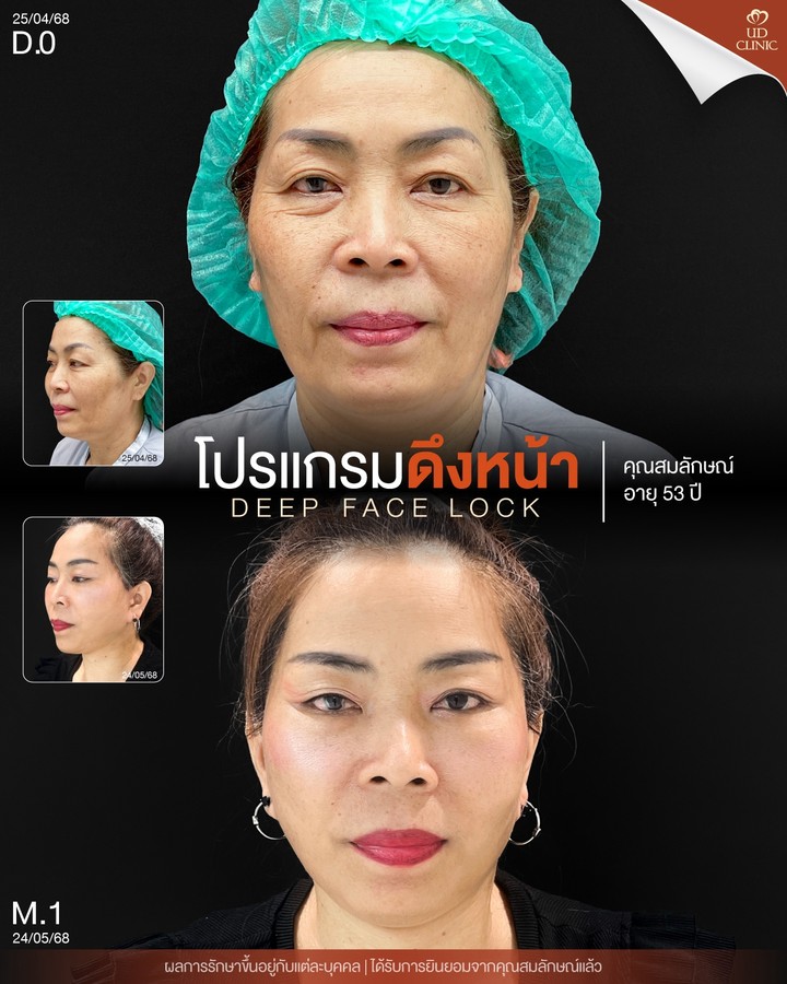 LINE_ALBUM_UD-ศัลยกรรมดึงหน้า 2_261012_2