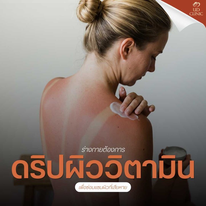 37.2 UD _ แดดเมืองไทยร้อนจนผิวไหม้ ดริปผิววิตามินสูตรกู้ผิวไหม้แดด (Sunburn) ช่วยฟื้นฟูเร่งด่วนได้อย่างไร