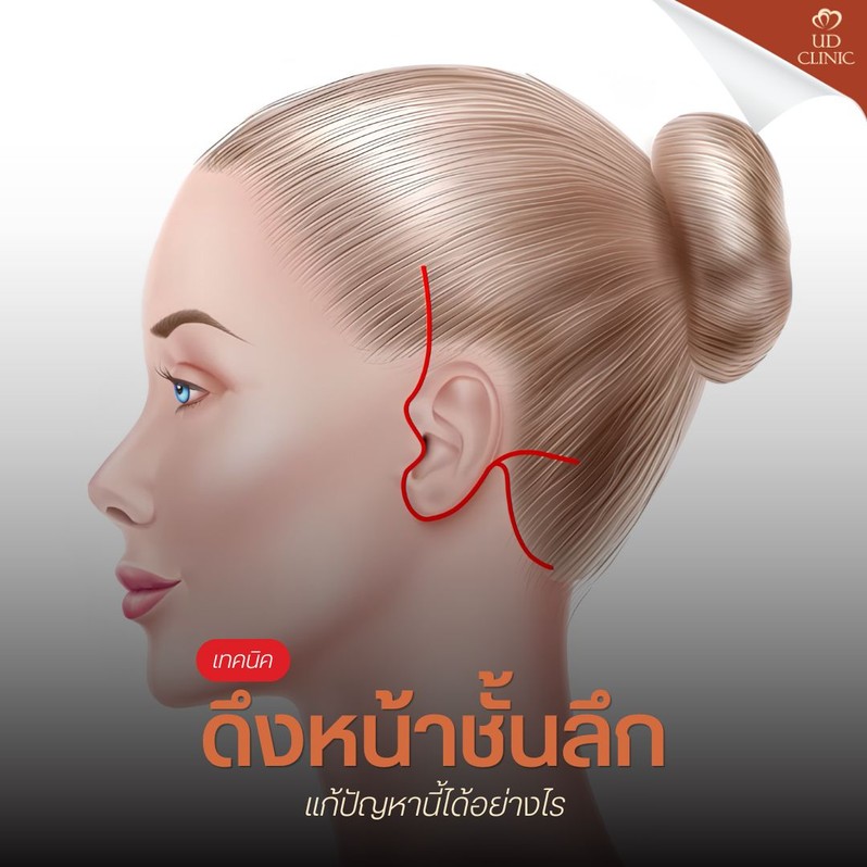 27.2 ส่องกระจกแล้วหน้าดูอมทุกข์_ แก้ไขปัญหามุมปากตกและร่องน้ำหมากด้วยเทคนิคดึงหน้าชั้นลึก