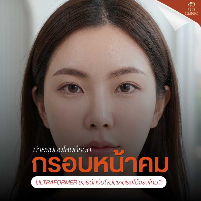 7.2 UD _ นวัตกรรมกรอบหน้าคมถ่ายรูปมุมไหนก็รอด Ultraformer ช่วยดักจับไขมันเหนียงได้จริงไหม_