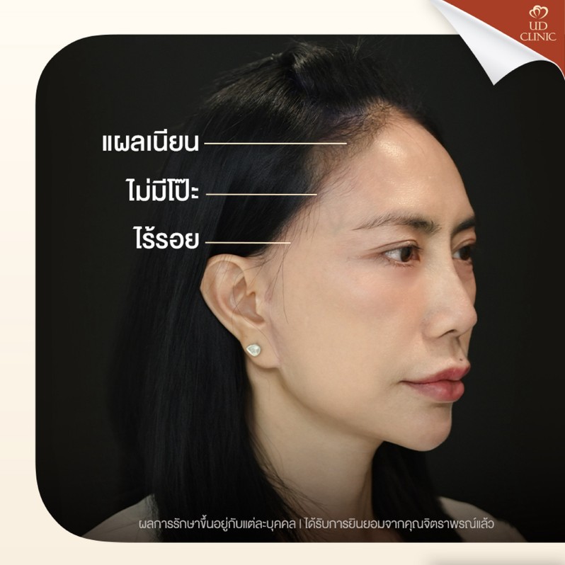 LINE_ALBUM_UD-ศัลยกรรมดึงหน้า 2_260818_2