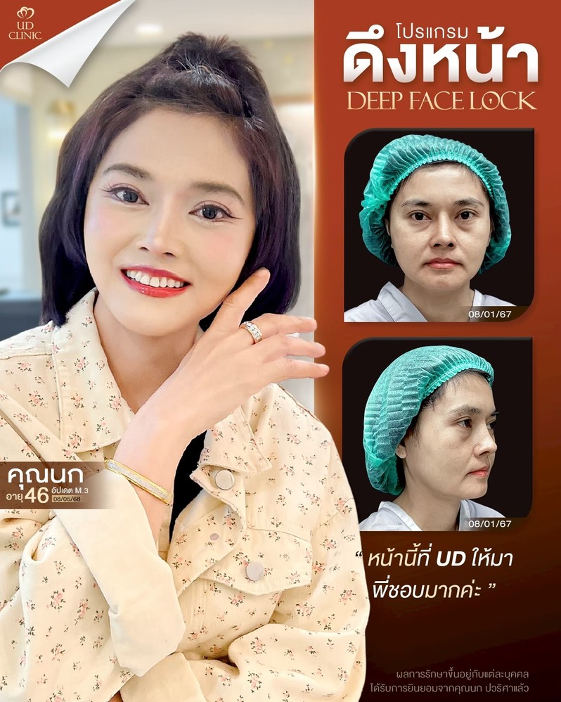 LINE_ALBUM_UD-ศัลยกรรมดึงหน้า 2_260901_1