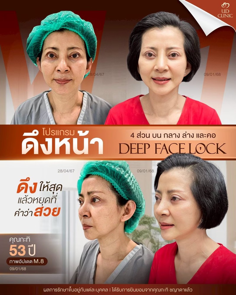 LINE_ALBUM_UD-ศัลยกรรมดึงหน้า 2_260901_2