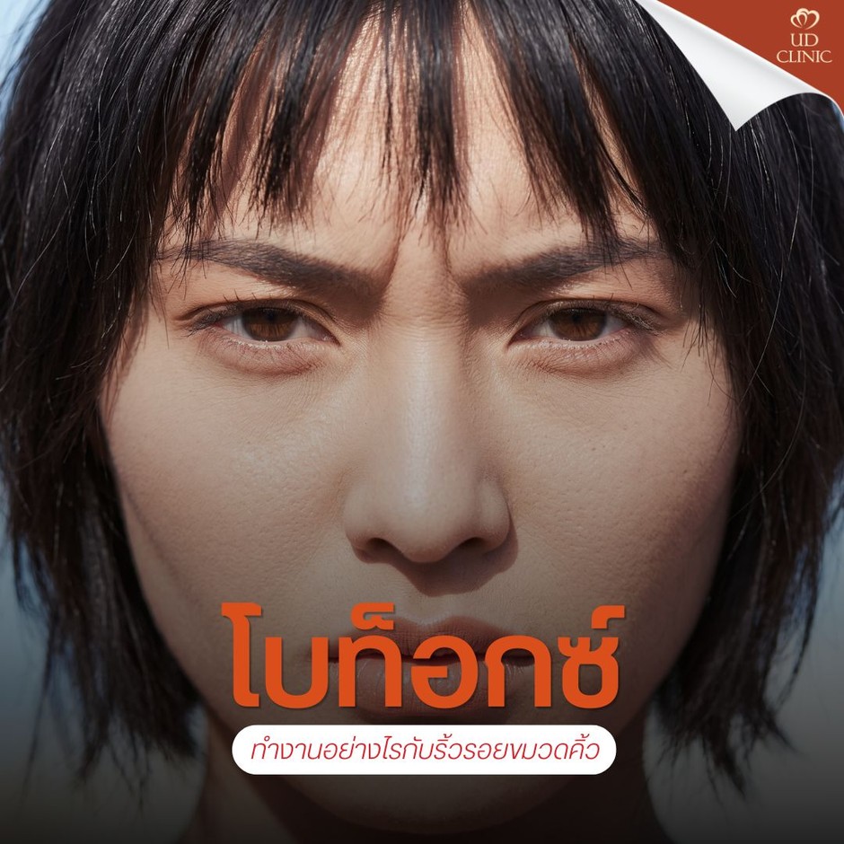 1.2 UD _ ติดซีรีส์ยันตีสองจนติดนิสัย _ขมวดคิ้ว_  รู้ตัวอีกทีริ้วรอยลึก โบท็อกซ์กู้หน้าเครียดทันไหม_
