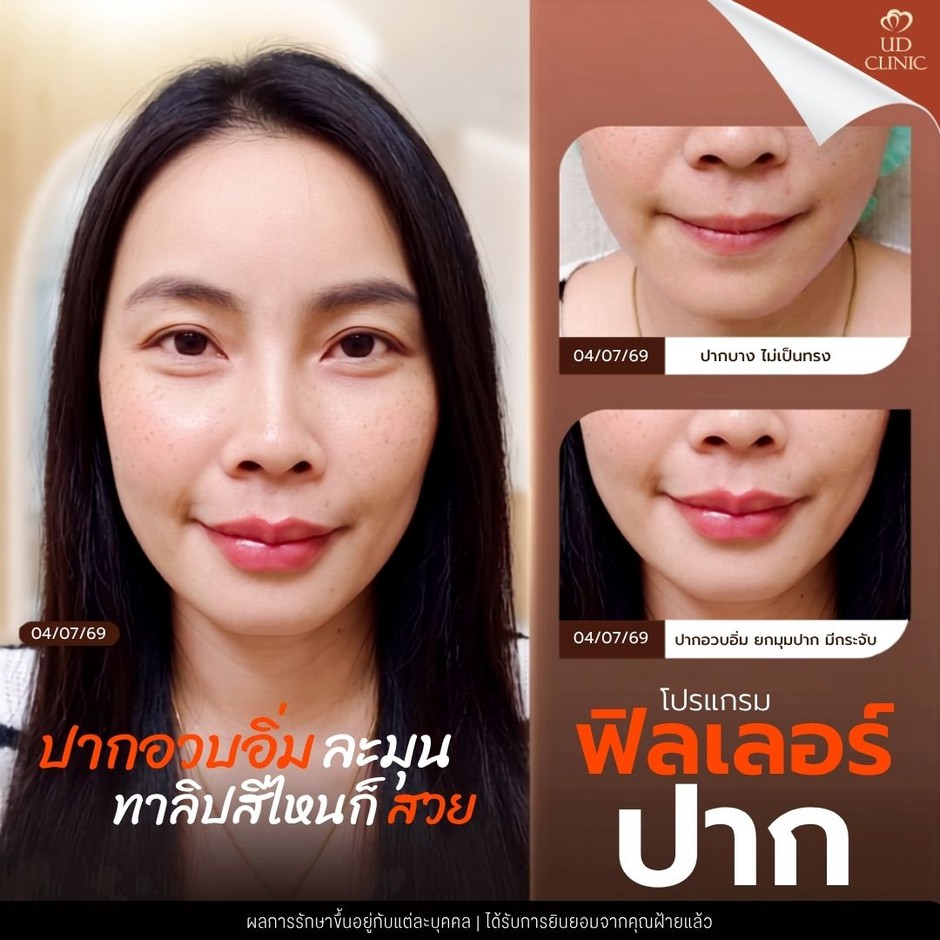 24.4 UD _ ฟิลเลอร์ปาก ทำแล้วดูดีไหม เลือกทรงอย่างไรให้เข้ากับใบหน้า