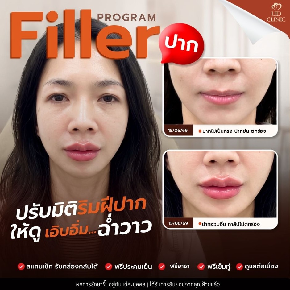 24.5 UD _ ฟิลเลอร์ปาก ทำแล้วดูดีไหม เลือกทรงอย่างไรให้เข้ากับใบหน้า