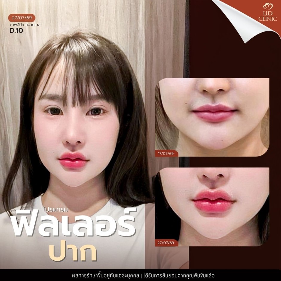 24.3 UD _ ฟิลเลอร์ปาก ทำแล้วดูดีไหม เลือกทรงอย่างไรให้เข้ากับใบหน้า