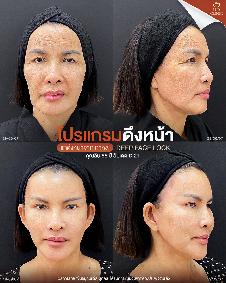 LINE_ALBUM_UD-ศัลยกรรมดึงหน้า 2_260918_2