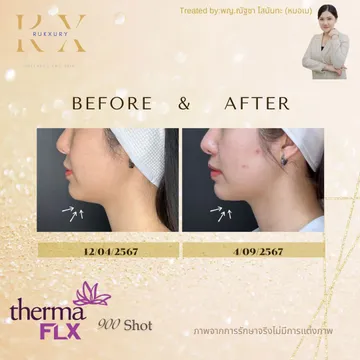 Thermage-FLX2