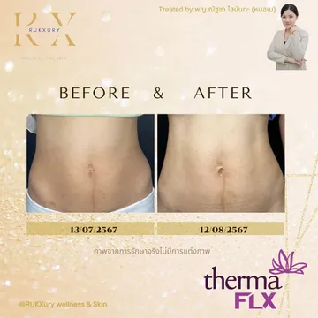 Thermage-FLX3