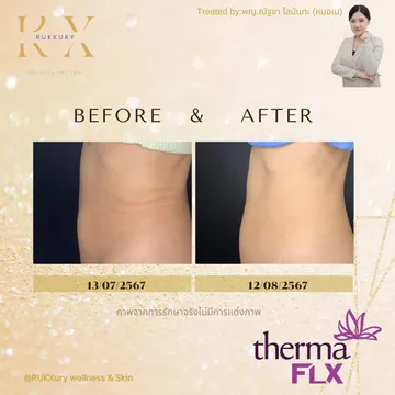 Thermage-FLX4