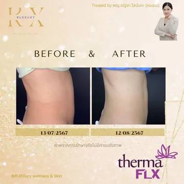 Thermage-FLX5