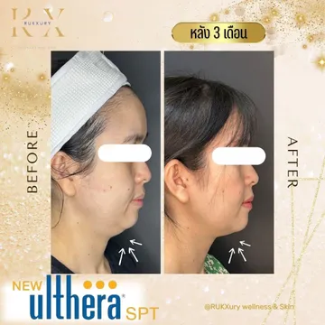 UltherapySPT2