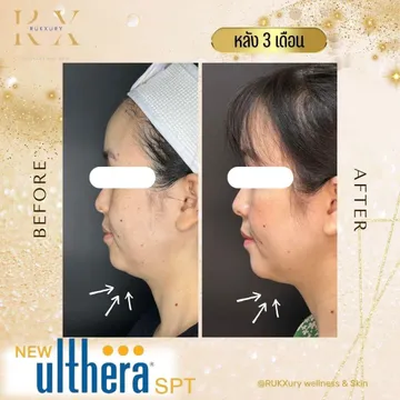 UltherapySPT3