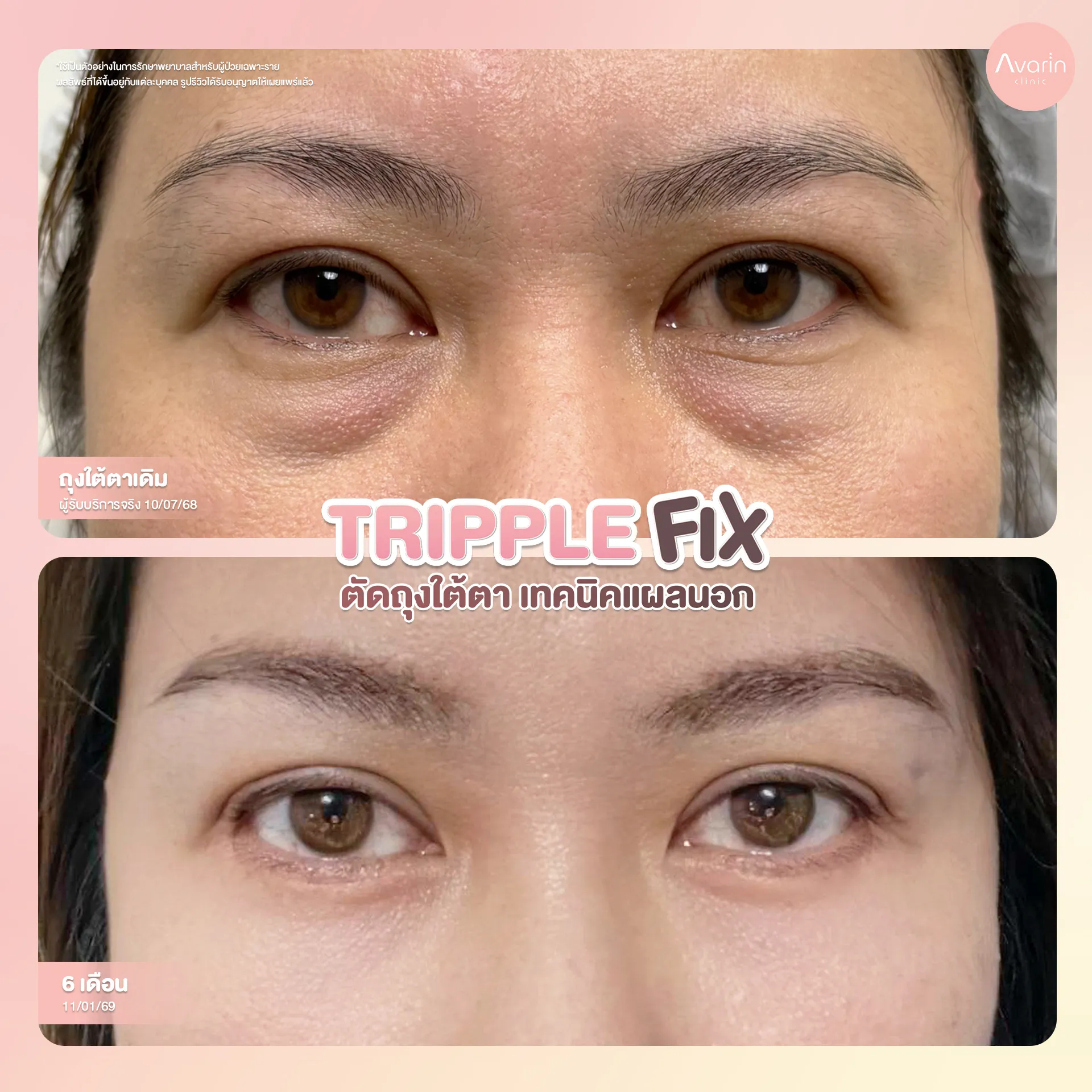 B&A-ตาล่าง-แอน-6เดือน
