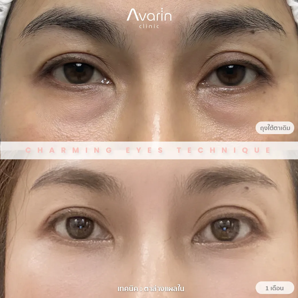 B&A-อุ้ย-1เดือน