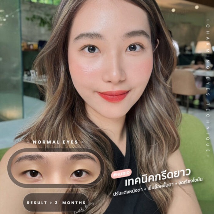 ทำตาสองชั้นกรีดยาวเก็บหนังตาส่วนเก