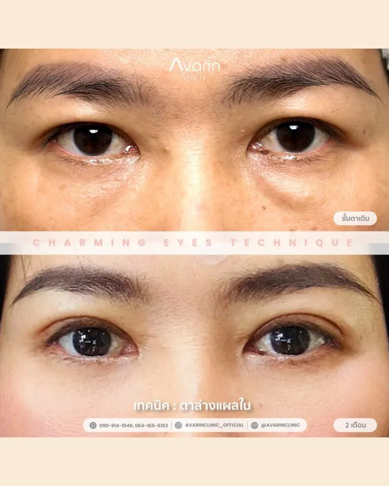 ผ่าตัดถุงใต้ตา68743240557931562020595045