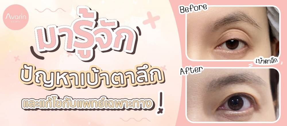 เบ้าตาลึก