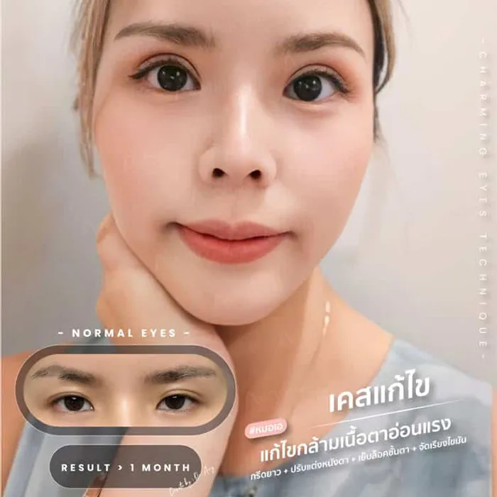 แก้ตาที่เคยทำมา