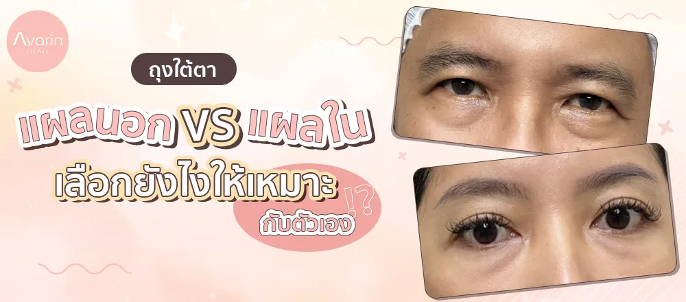แผลนอกแผลใน