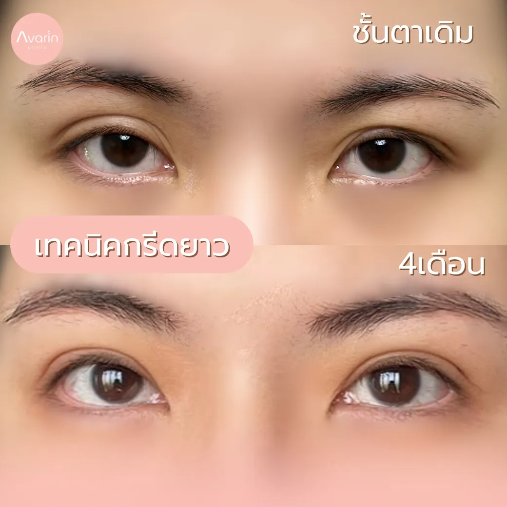 ก่อนทำ