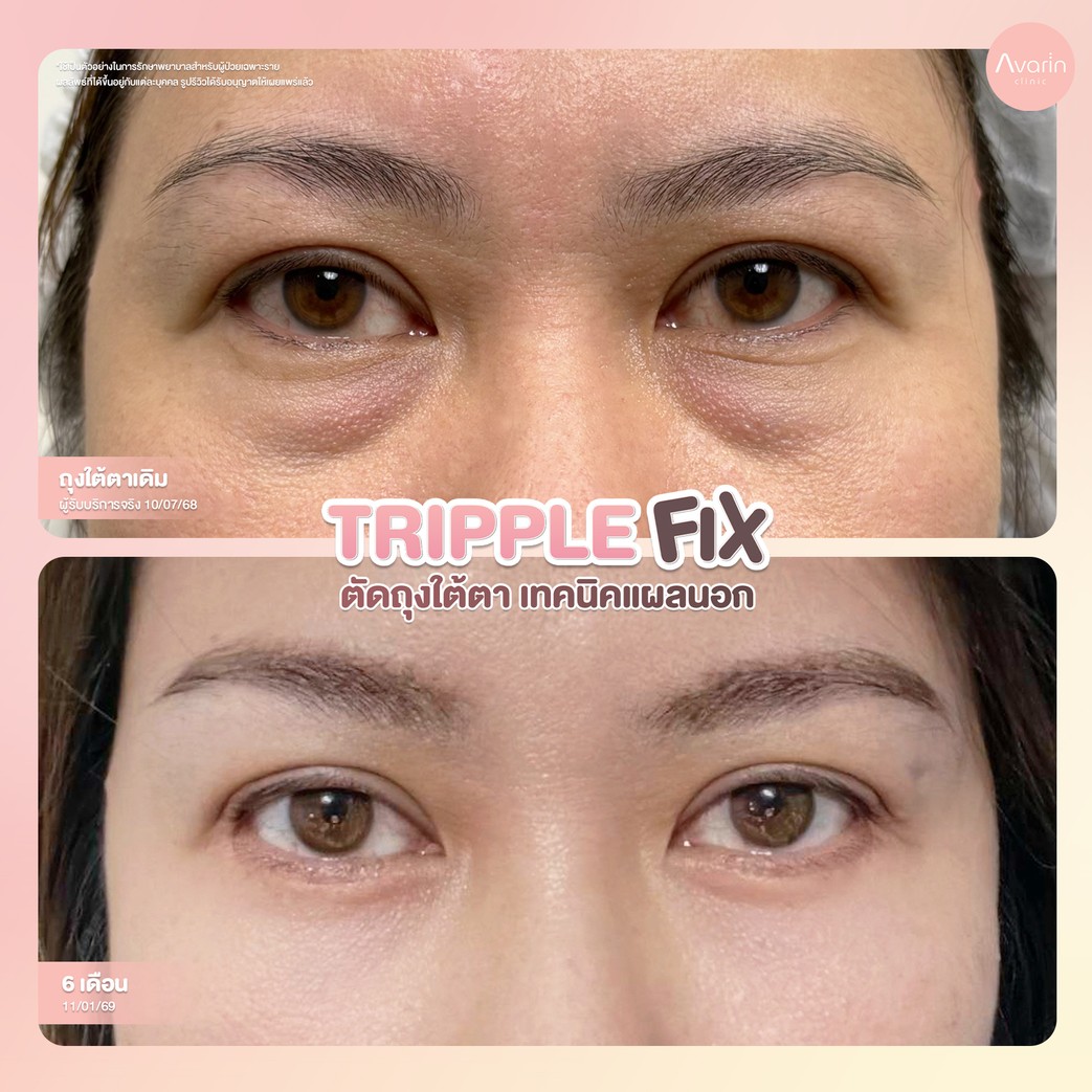 B&A-6months