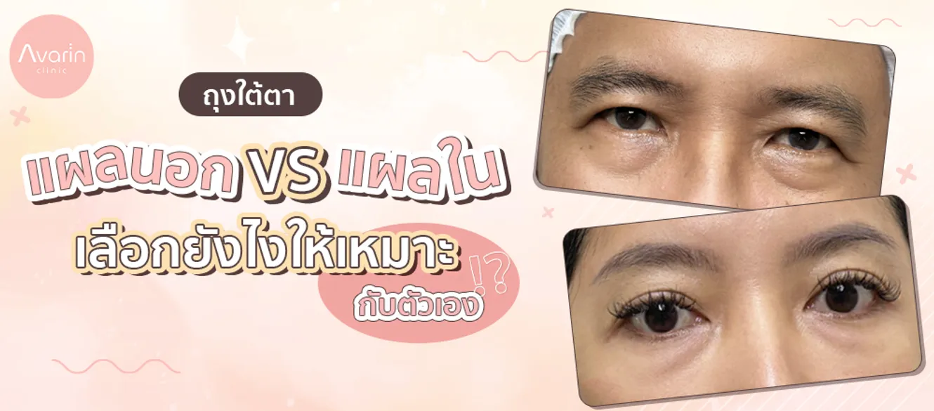 แผลนอกแผลใน