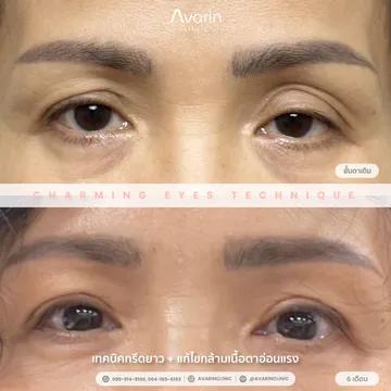 B&A-6เดือน