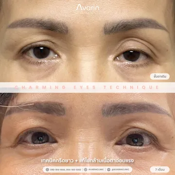 B&A-7เดือน