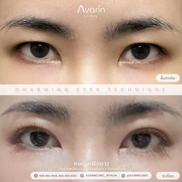 B&A-กิ๊ฟ-6เดือน