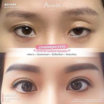 B&A-จูน-5เดือน
