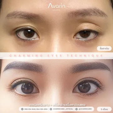B&A-จูน-5เดือน