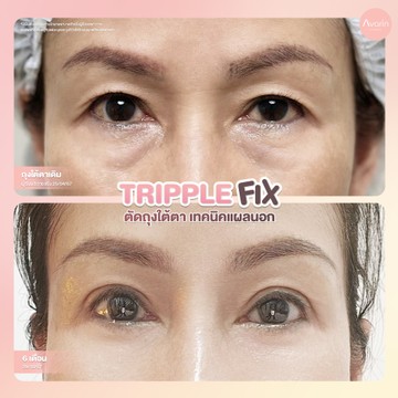 B&A-ตาล่างใหม่-6เดือน