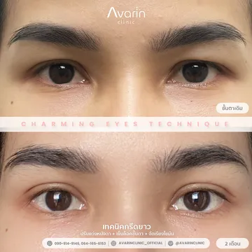 B&A-ทีน-2เดือน