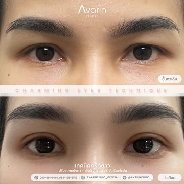 B&A-ทีน-3เดือน