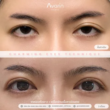 B&A-ป๊อป-3เดือน