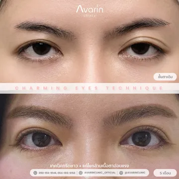 B&A-ป๊อป-6เดือน