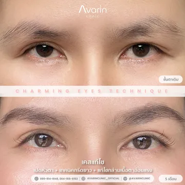 B&A-ออม-5เดือน